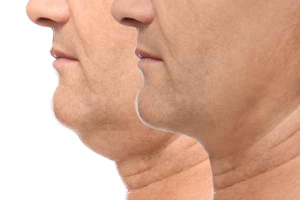 HIFU - Breakthrough in Anti - ageing 2 hifu results East Sussex