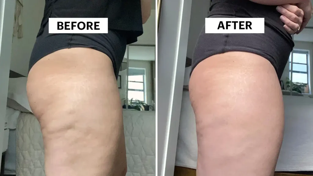 Sculpting Your Bum: Can Toning Exercises Really Reduce Cellulite? 1 Do Toning Exercise East Sussex Really Tackle Cellulite?