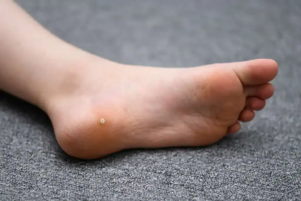 Cryotherapy For Warts And Also Verrucas 2 Image of verruca on the bottom of the foot that able to be treated with Cryotherapy East Sussex