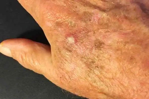 Image of Actinic keratoses  East Sussex on a person hand