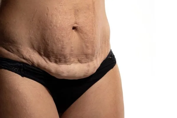 The science behind skin tightening  East Sussex picture of a woman's sagging skin on the stomach